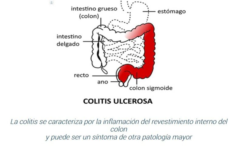 Qué Es La Colitis Descubre Los Síntomas Más Comunes Recursos Escolares 9855